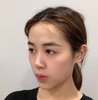 济南艺星整形医院冯雪丽 抗衰介绍