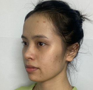 广州华美医疗美容整形医院郑志芳磨骨介绍