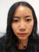 上海诗诺雅医疗美容医院许祐荣假体隆鼻介绍