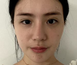 深圳晨曦医疗美容门诊部朱春艳脂肪填充介绍