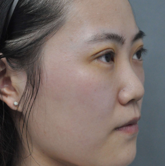 广州华美医疗美容整形医院袁耀东仿生态重睑介绍
