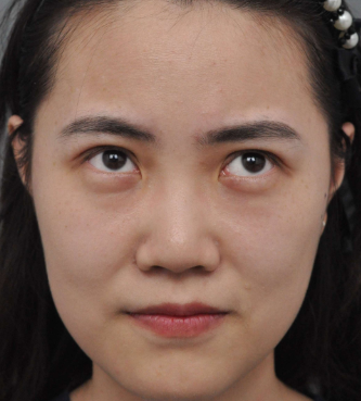 广州华美医疗美容整形医院袁耀东仿生态重睑介绍