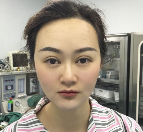 广州华美医疗美容整形医院张明兴假体丰下巴介绍