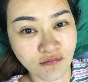 广州华美医疗美容整形医院张明兴假体丰下巴介绍