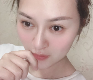 广州华美医疗美容整形医院张明兴假体丰下巴介绍