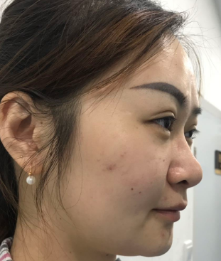 广州华美医疗美容整形医院张明兴假体丰下巴介绍