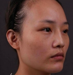 广州华美医疗美容整形医院张明兴除皱瘦脸介绍