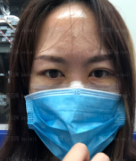 济南微著整形美容医院张鑫萌自体脂肪除皱介绍