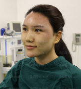 济南微著整形美容医院张鑫萌自体脂肪全脸填充介绍