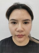 上海诗诺雅医疗美容医院杨礼鼻修复介绍