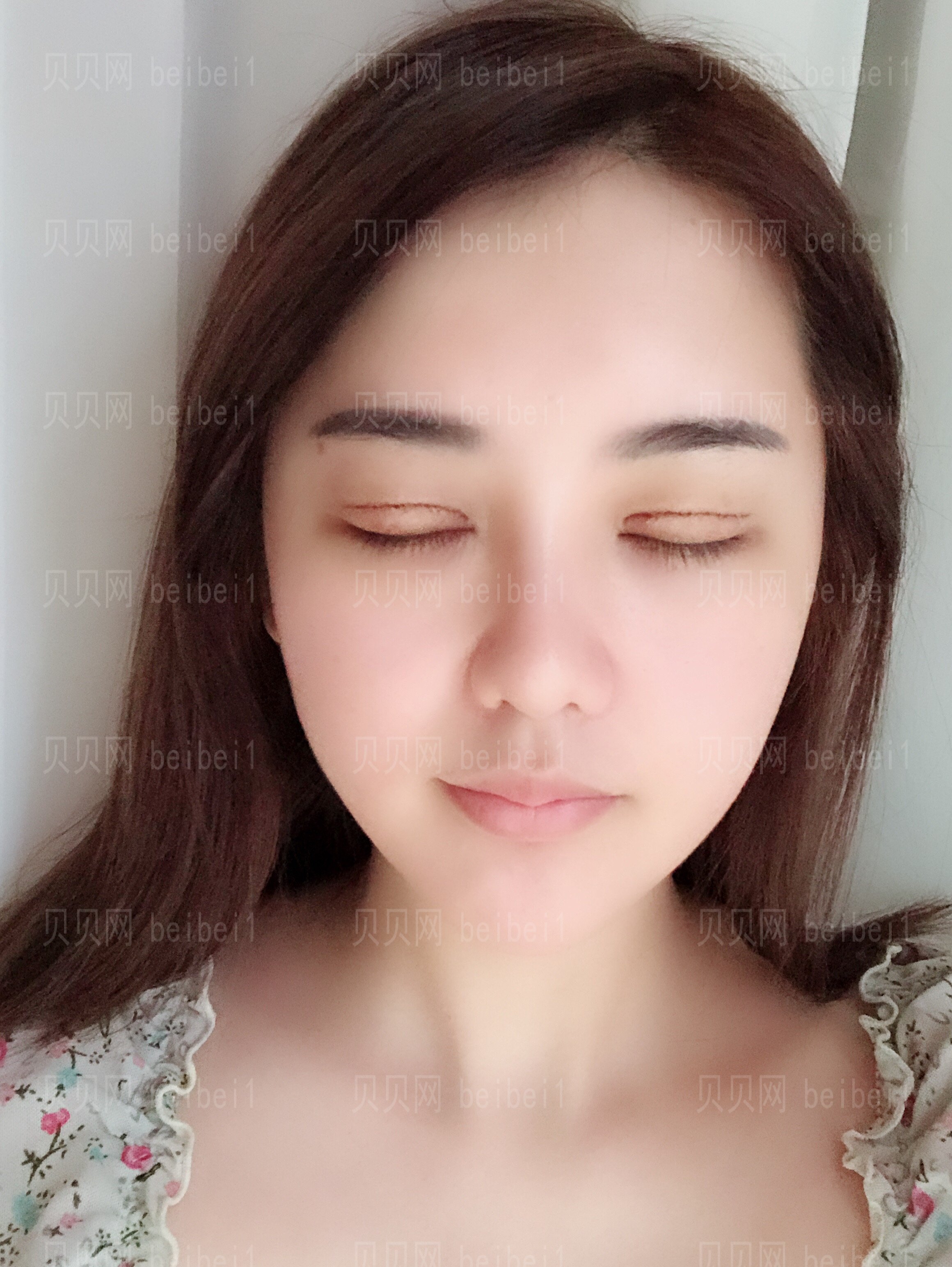 上海诗诺雅医疗美容医院杨礼双眼皮修复介绍