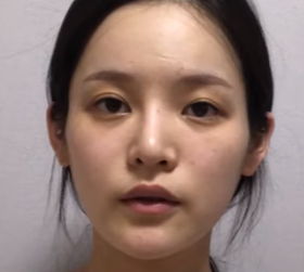 广州华美医疗美容整形医院郑志芳热拉提介绍