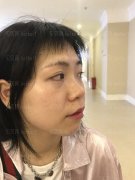 上海诗诺雅医疗美容医院陈小伟隆鼻介绍