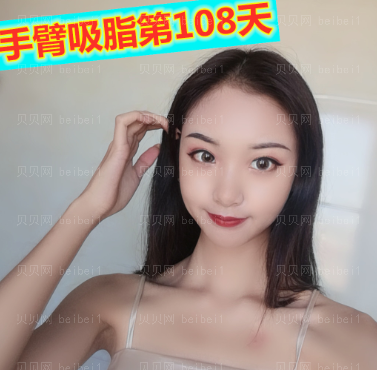 广州新时代医院王红娟 手臂吸脂介绍