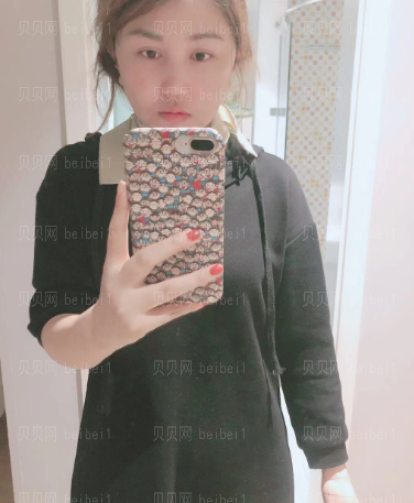 济南艺星整形医院杜娟 吸脂介绍
