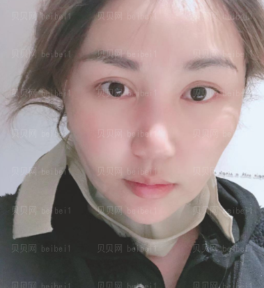 济南艺星整形医院杜娟 吸脂介绍