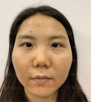 广州华美医疗美容整形医院易阳亮祛除痘印介绍