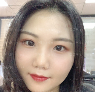 广州华美医疗美容整形医院易阳亮祛除痘印介绍