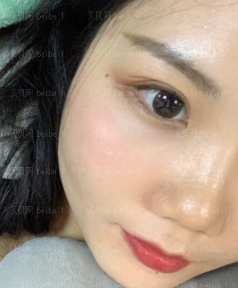 广州华美医疗美容整形医院易阳亮祛除痘印介绍