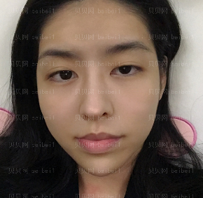 深圳博美医疗美容整形医院王红玮埋线提升介绍