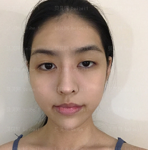 深圳博美医疗美容整形医院王红玮埋线提升介绍