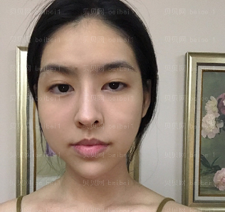 深圳博美医疗美容整形医院王红玮埋线提升介绍