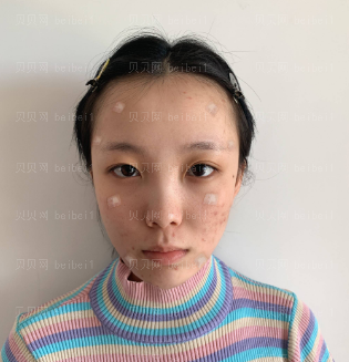 深圳晨曦医疗美容门诊部朱春艳自体脂肪填充介绍