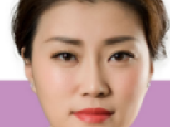 深圳晨曦医疗美容门诊部朱春艳全切双眼皮介绍