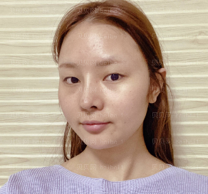 深圳晨曦医疗美容门诊部朱春艳全切双眼皮介绍