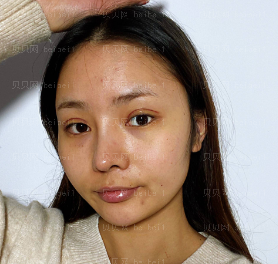 深圳晨曦医疗美容门诊部朱春艳全切双眼皮介绍
