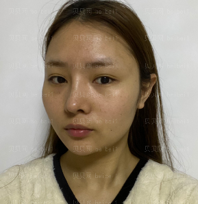 深圳晨曦医疗美容门诊部朱春艳全切双眼皮介绍