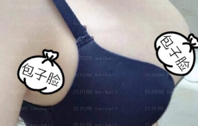 重庆美莱整形医院隆胸介绍分享!