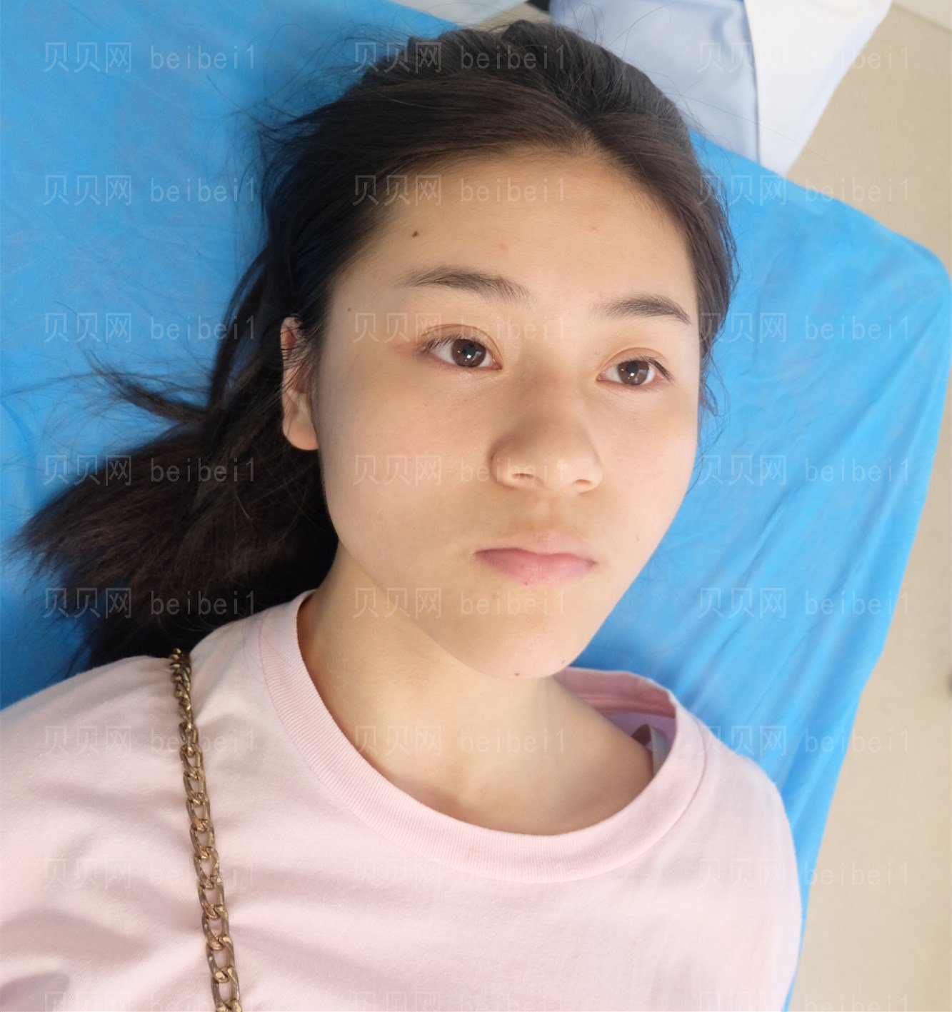 重庆美莱医师郑楠做的膨体隆鼻介绍分享，天仙鼻只花了10000！