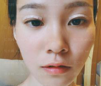 广州新时代医院黄罡双眼皮介绍片较新分享-终于摆脱单眼皮了啊