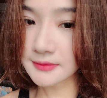 济南艺星医疗美容医院胡晶埋线提升介绍片较新分享_现在是手术恢复期,静候我蜕变呀~