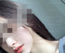 济南艺星医疗美容医院胡晶热玛吉介绍片较新分享_看见脸蛋儿确实紧实了不少~