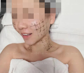 济南艺星医疗美容医院刘近兰热玛吉介绍片较新分享_全场感受下来真的很不错真心实意强烈名单！！哈哈