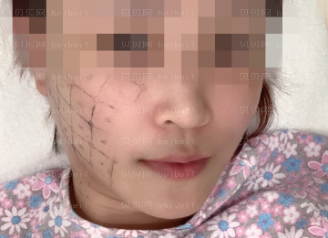 济南艺星医疗美容医院刘近兰热玛吉介绍片较新分享_全场感受下来真的很不错真心实意强烈名单！！哈哈