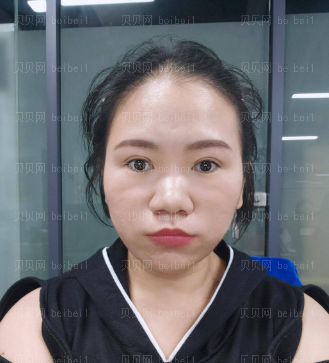 济南艺星医疗美容医院刘近兰热提拉介绍片较新分享_人眼由此可见苹果肌上移了，脸也变小了