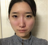 济南艺星医疗美容医院齐红艳埋线提升案例图片最新分享_如今见到自己脸部的变化，心态也变好啦呢！