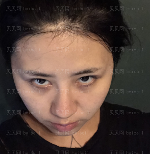 深圳壹美健医疗美容门诊部李甜埋线提升介绍片较新分享_脸部皮肤紧了,光泽度也好了许多,给了我过多意外惊喜了~