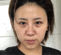 深圳壹美健医疗美容门诊部李甜面部埋线提升介绍片较新分享_现如今不仅紧致皮肤,脸也小了一圈呀