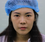 济南添美医疗美容医院王乐去眼袋介绍片较新分享——没了眼袋就像变了一个人