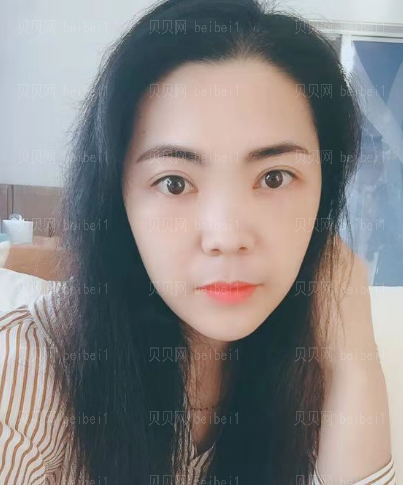 济南添美医疗美容医院王乐去眼袋介绍片较新分享——没了眼袋就像变了一个人