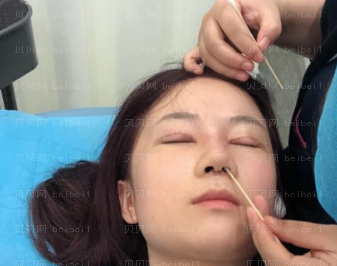 深圳华美整形医院李宁江隆鼻+双眼皮修复介绍片较新分享_手术没有让我失望奥!