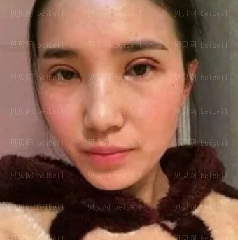 深圳壹美健医疗美容整形医院沈婉儿双眼皮介绍片较新分享_眼睛变大了好多啊~