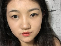 深圳壹美健医疗美容整形医院沈婉儿重睑介绍片较新分享_嘿嘿不得不说做好护理，恢复真的很块呀！