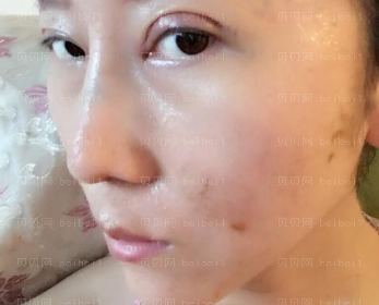 深圳广尔美丽医疗美容医院王天国膨体隆鼻介绍片较新分享_很期待我的鼻子后面恢复好的样子！