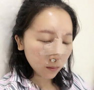 深圳广尔美丽医疗美容医院王天国膨体隆鼻介绍片较新分享_很期待我的鼻子后面恢复好的样子！