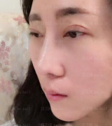 深圳广尔美丽医疗美容医院王天国隆鼻介绍片较新分享_想要去动手术的别犹豫啦